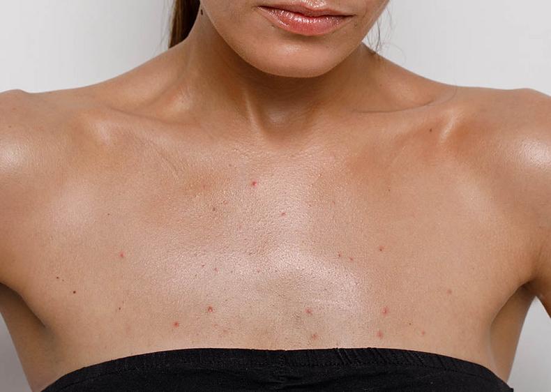 What causes chest acne? [NeutriherbsNigeria]