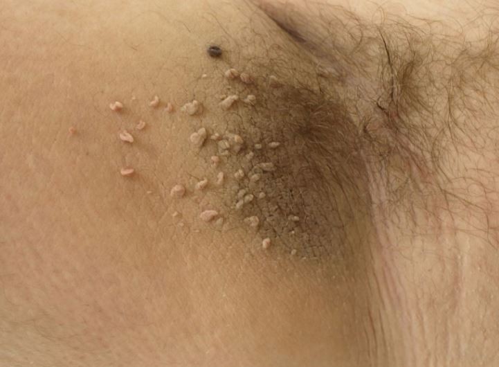 anal für anfänger haut an der eichel anal für anfänger haut an der eichel