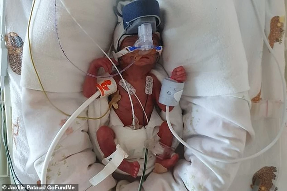 Mala Amalija je na rođenju imala 411 grama