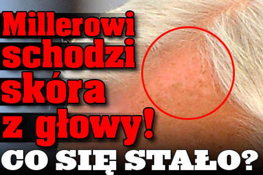 Millerowi schodzi skóra z głowy! Co się stało?