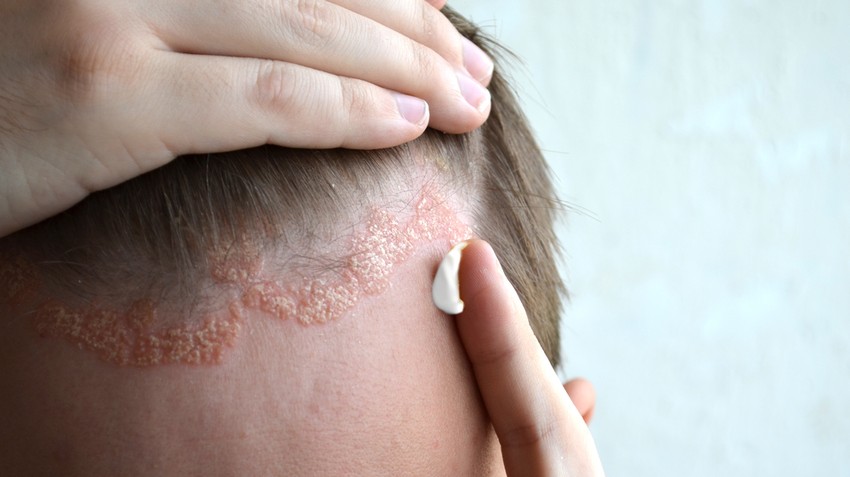 Pikkelysömör (pszoriázis, psoriasis) tünetei és kezelése - HáziPatika