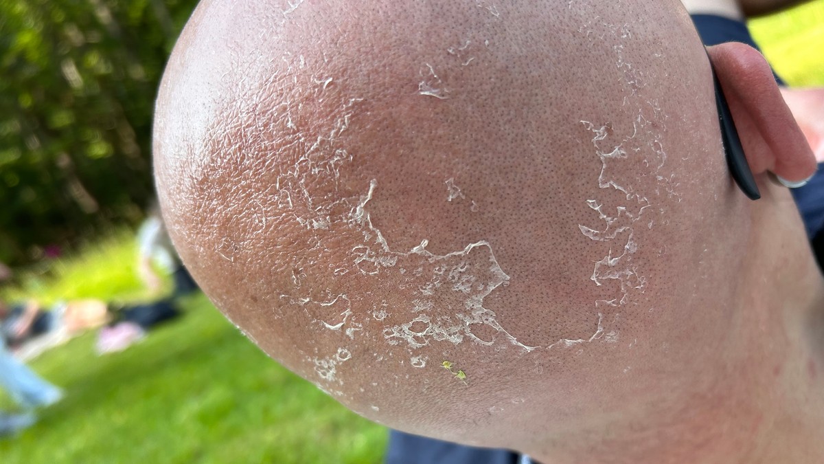 Opekotine od sunca na glavi