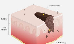 Czerniak skóry - wszystko, co musisz wiedzieć o tym nowotworze INFOGRAFIKA