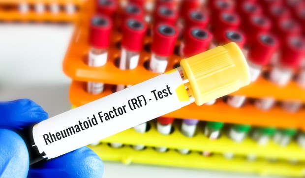 Reumatoidni faktor se testira pomoću analize krvi