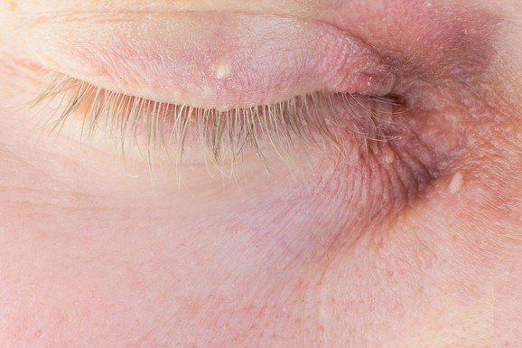 Znaci raka kože mimo mladeža: Dermatolog iz Londona opisao karakteristične kraste, mrlje, perut vredan pažnje