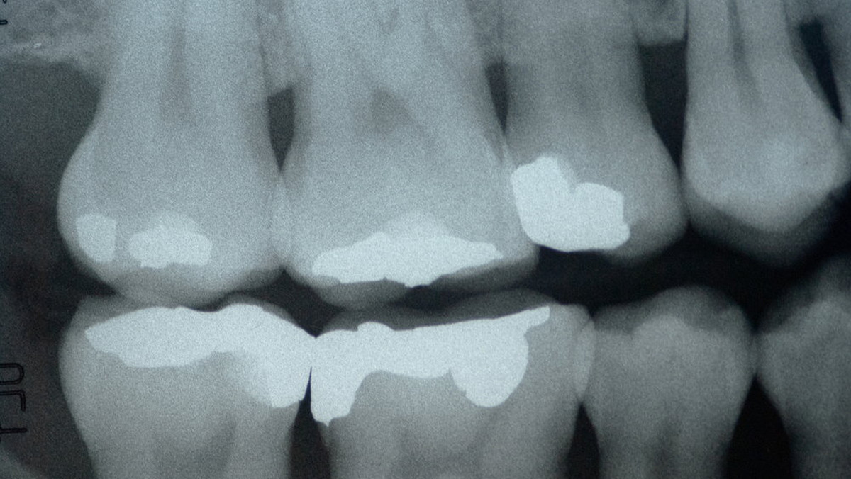 Emily Lallouz to mieszkanka Los Angeles, która ostatnio przeżyła niemałe zaskoczenie u dentysty. Kobieta była zmuszona podjąć leczenie kanałowe, a pod jej zębem ukryty był kawałek plastiku. Okazało się, że to składnik popularnych past do zębów.