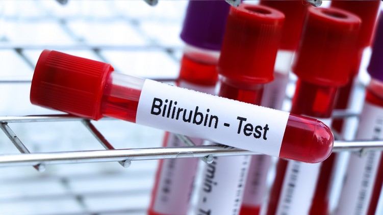 Mit jelent bilirubin érték laborlelet