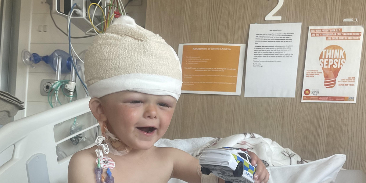 Mały Beau z Wielkiej Brytanii przeszedł skomplikowaną operację czaszki.