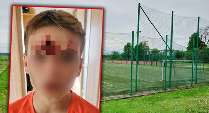 Zawistny nastolatek wygryzł piłkarzowi dziurę w czole. Przeszczep się przyjmie? Lekarze mają wątpliwości