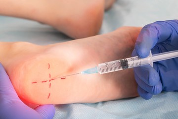 Bizonyos esetekben a kortizoszteroidos injekciók segíthetnek a gyulladás csökkentésében és a fájdalom enyhítésében. Injekciós terápia céljából keresse fel fájdalomterapeuta szakorvosát.