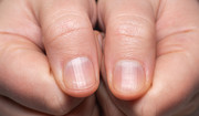 Co paznokcie mówią o zdrowiu? To może być pierwszy sygnał ostrzegawczy