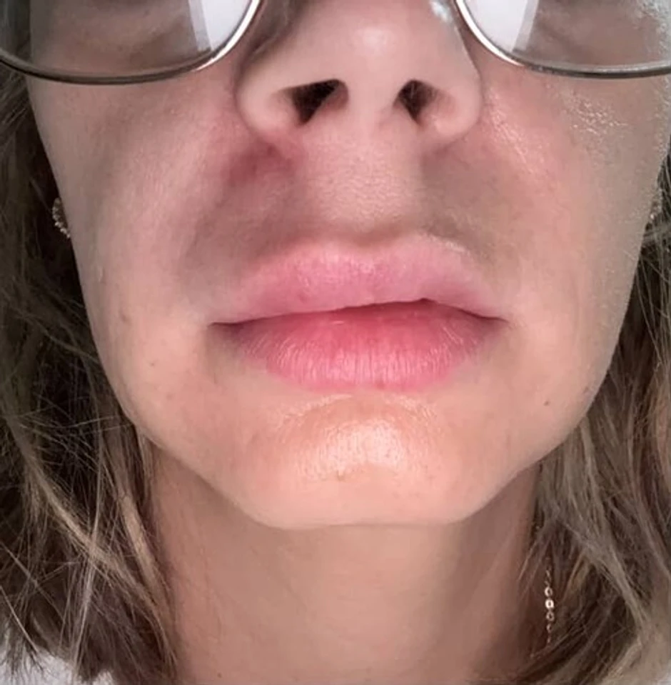 Bubuljica na dnu nosa napravila haos