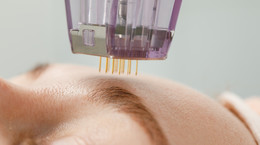 Mezoterapia igłowa twarzy odmładza skórę. Przebieg, efekty, cena