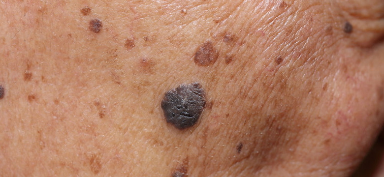 Kobieta, która cierpi na raka skóry, publikuje w sieci wstrząsające zdjęcie twarzy