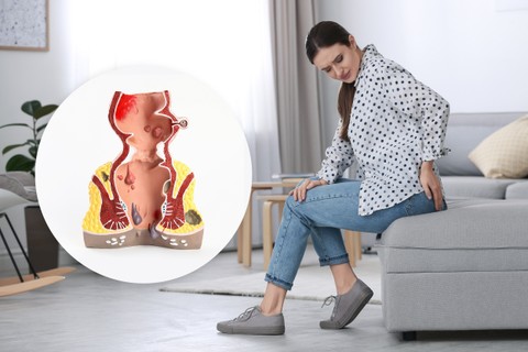 Aranyér: tévhit, hogy csak az idősek betegsége, 20 évesen is kialakulhat