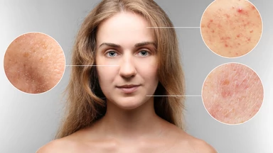 Hormony kontra skóra - fakty i mity