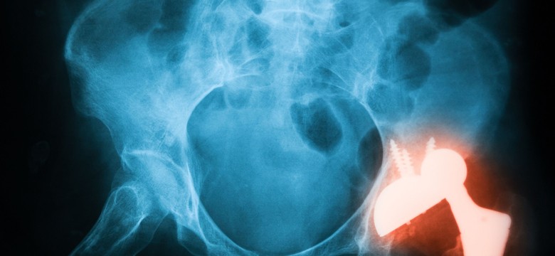 Zmiany na rynku implantów ortopedycznych w Polsce: MedTech Solutions z wyłącznością na implanty GPC Medical