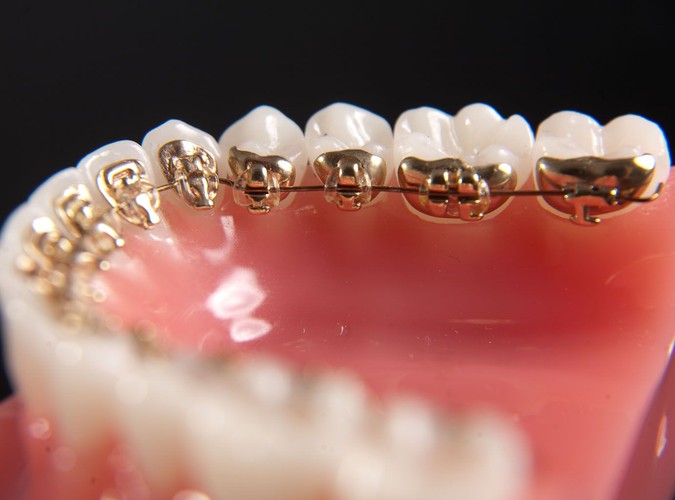 Rolls Royce wśród aparatów ortodontycznych