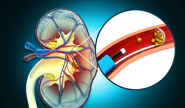 Kamen u bubregu jako boli kada dolazi do njegovog izbacivanja 