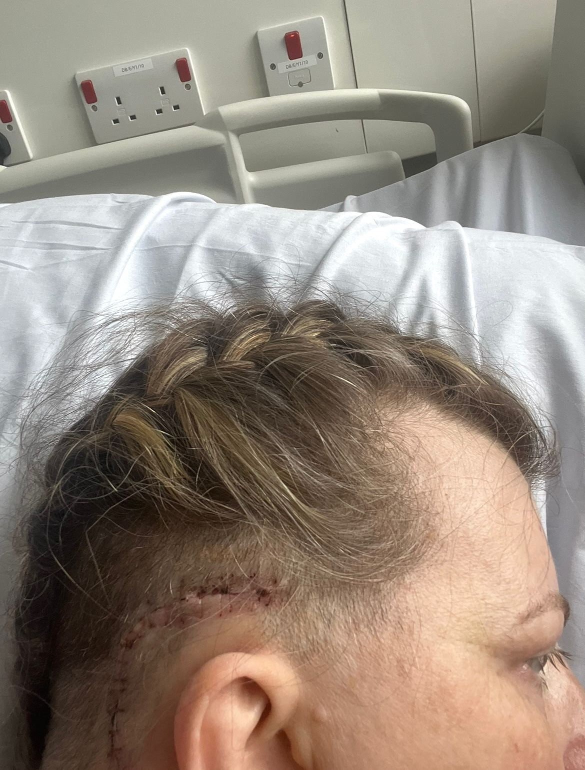 Lekári Tracy našli nádor za pravým uchom.