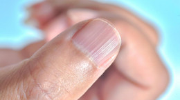 Wykwity na paznokciach - czy to objaw choroby?