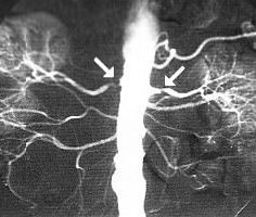 angiografia1-d00000E79a1e17aa4cabe