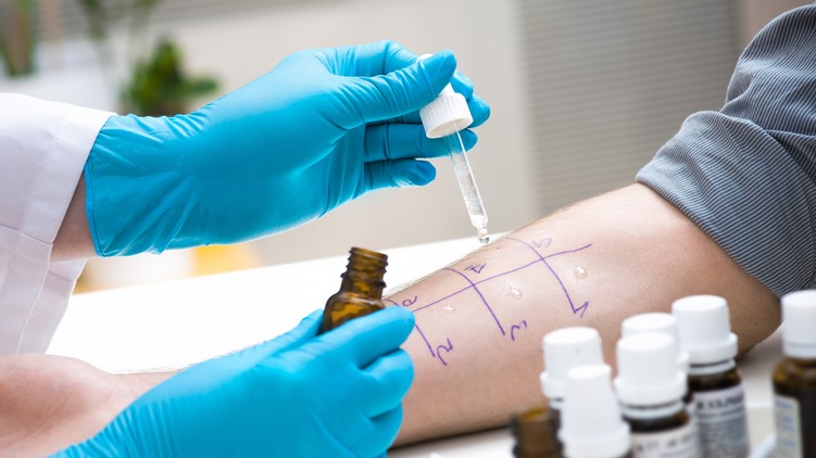 skin-prick-allergy-test1