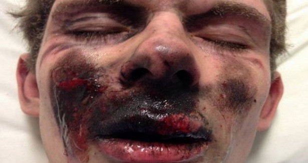 Tak wygląda twarz mężczyzny po wybuchu e-papierosa