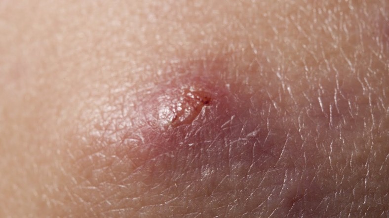 It's not safe to pop your boils open by yourself [Pulse Nigeria]