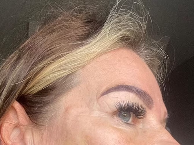 Natalija (53) posle tretmana zatezanja lica izgleda kao da ima crve u obrazu