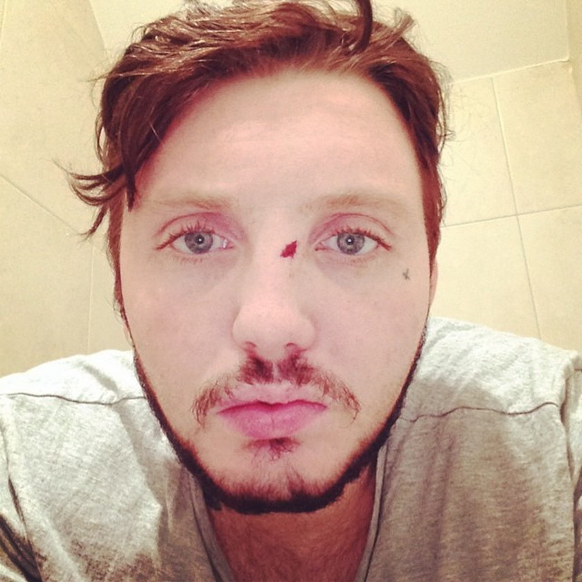 James Arthur z podbitym okiem