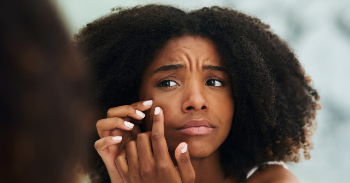 7 Skincare mistakes that are causing your Acne - Vimarsana News