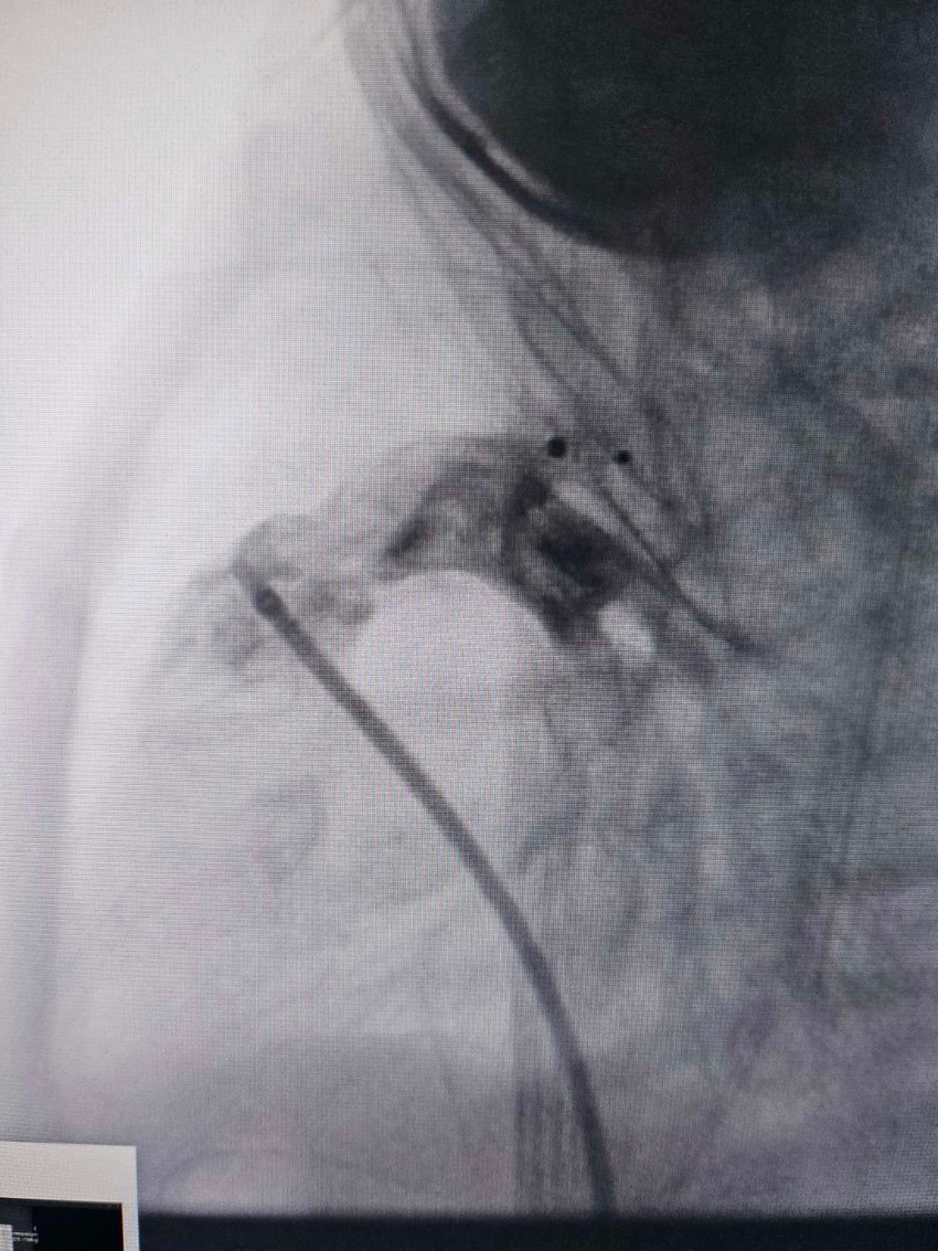 Direktno u krvni sud plasiran je minijaturni uređaj "Pikolo"