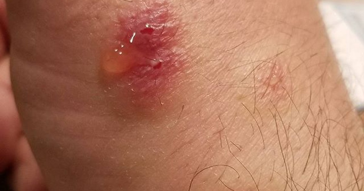 Do You Have a Spider Bite? These 7 Photos Can Help You Figure Out If It's  Serious