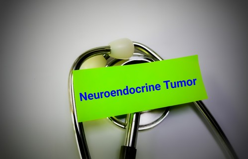 Neuroendokrin daganatok