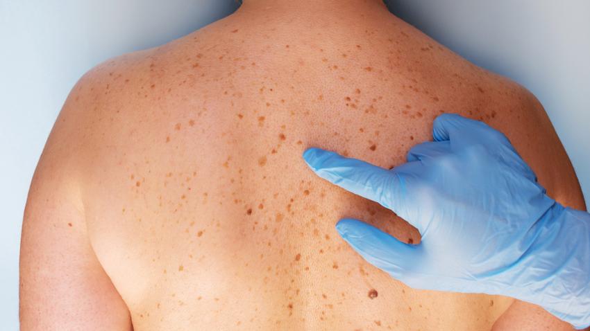 anyajegyszűrés, dermatológus, anyajegy, bőrrák, melanoma