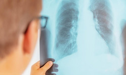 &quot;Sytuacja jest alarmująca”. Rak płuc to najczęstszy nowotwór w Polsce 