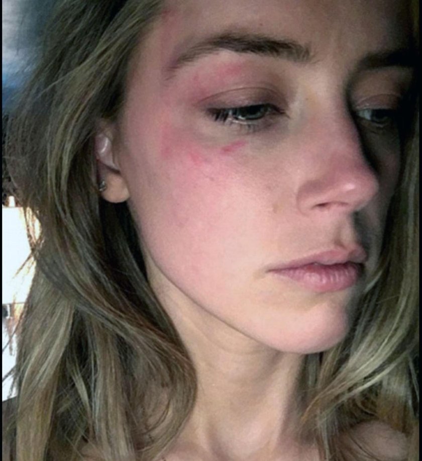 Amber Heard ze śladami przemocy domowej