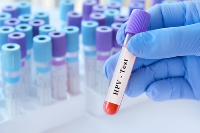 Elég a nőgyógyászati citológiai vizsgálat, vagy külön HPV-szűrés is indokolt? Az orvos válaszol