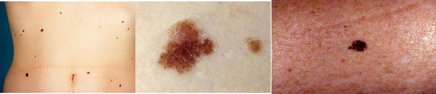 Desplastični nervusi