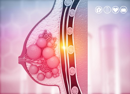 Jóindulatú emlődaganatok tünetei, vizsgálata és kezelési lehetőségei