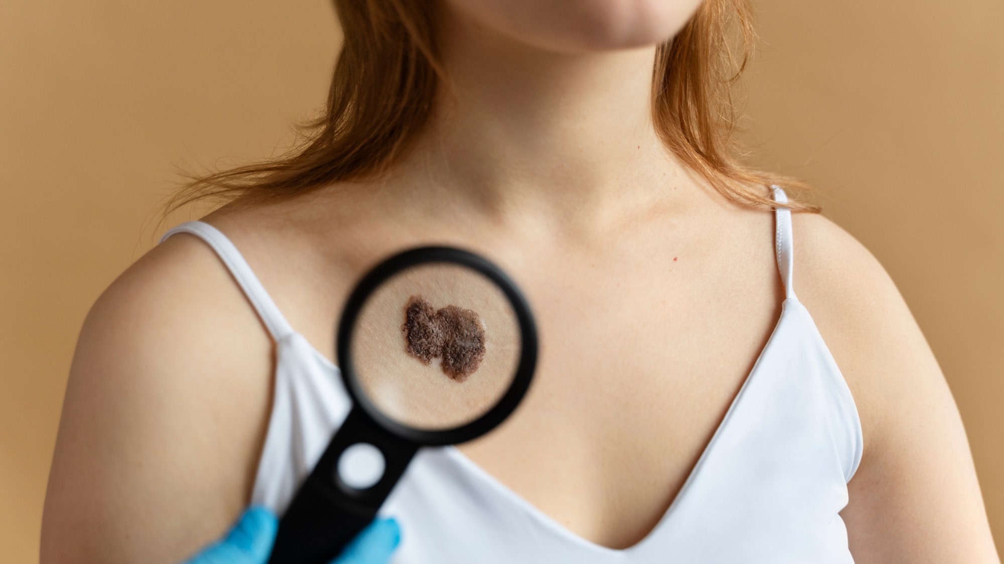 Pri rakovine žalúdka zbystrite pozornosť najmä pri náhlom výseve seboroických bradavíc.