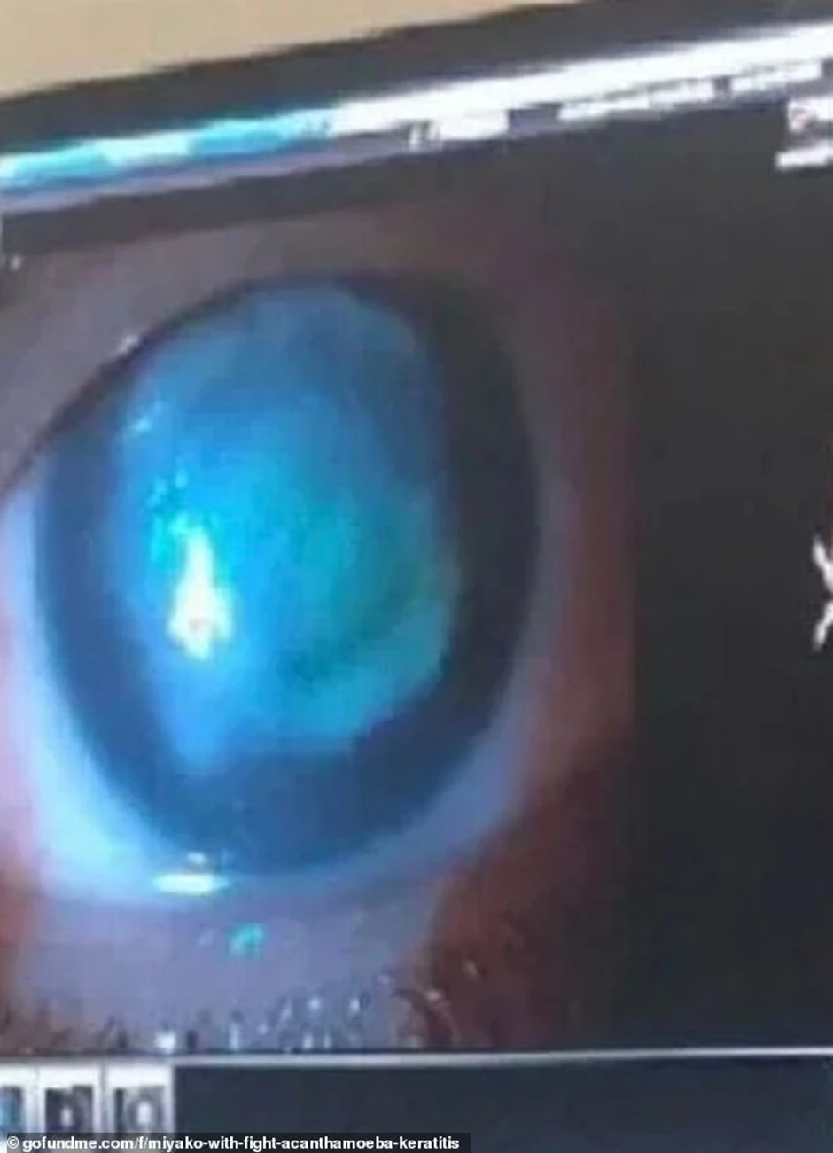 Mijakino oko se jako zacrvenelo, stalno je suzilo i imala je migrenu