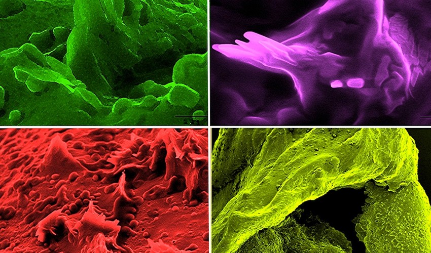 Kristali holesterola