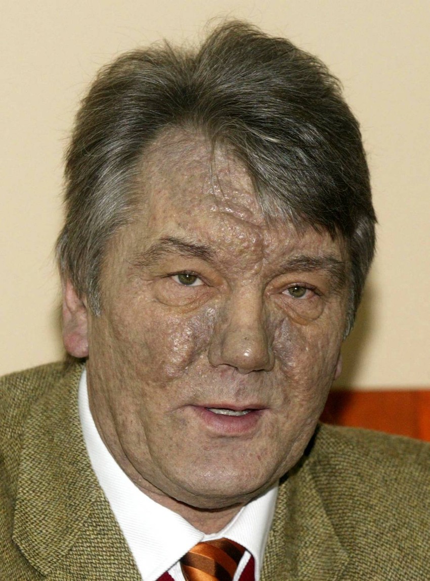 Unakaženog lica od dioksina: Viktor Juščenko