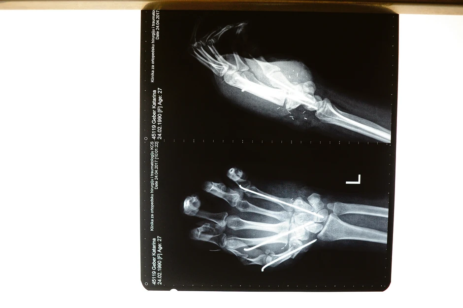 Posebnim iglama lekari su fiksirali kosti i krenuli na ušivanje tetiva. Za svaki prst ušili su najmanje dve tetive, ukupno više od 10