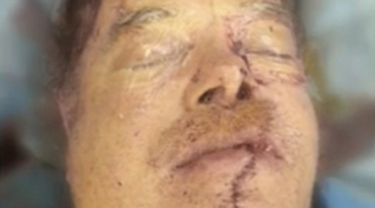 A 68 éves férfi véletlen vágta szét arcát egy láncfűrésszel favágás közben