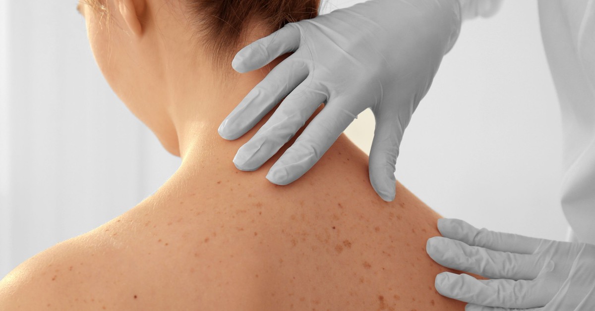 Rak kolczystokomórkowy skóry to choroba zawodowa. Jak się objawia