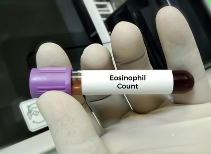 Mitől lehet magas a eosinophil a vérképben? Ezeket mindenképp tudnia kell! című cikk nyitóképe