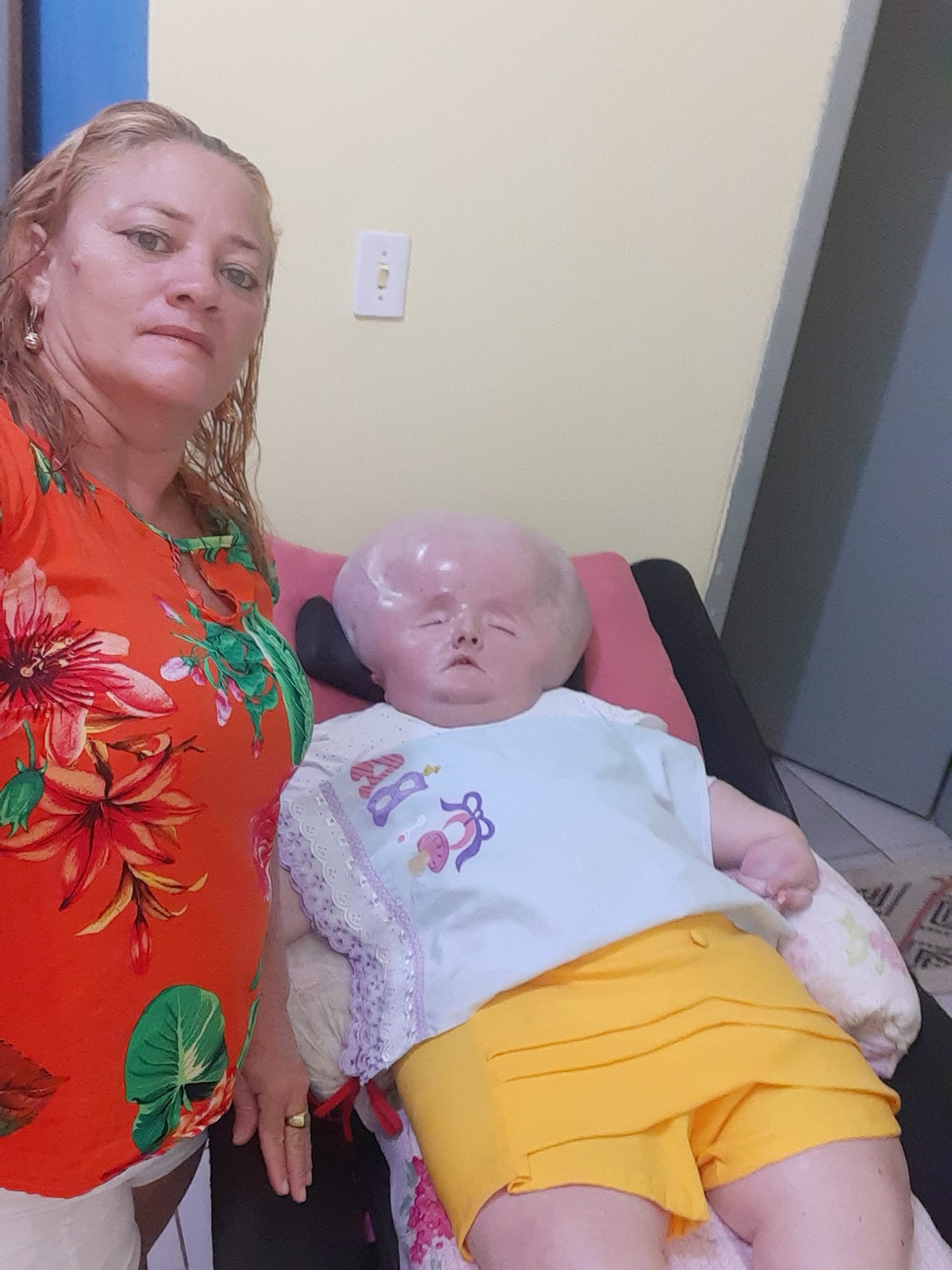 Žena z Brazílie od narodenia trpí nezvyčajnou chorbou.